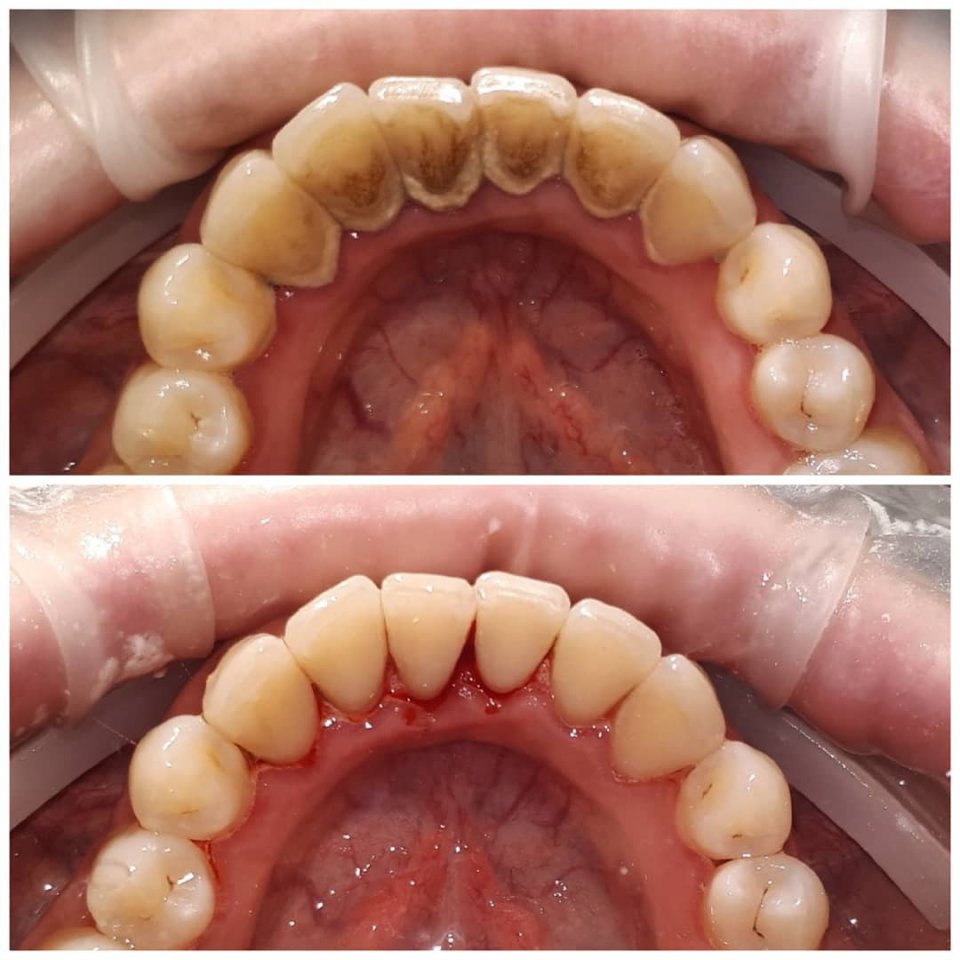 Чистка зубов: фото до и после